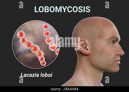 Lobomycosis fungal infection, illustration Stock Photo - Alamy