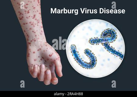 Rash in Marburg haemorrhagic fever, illustration Stock Photo - Alamy