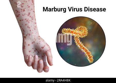 Rash in Marburg haemorrhagic fever, illustration Stock Photo - Alamy