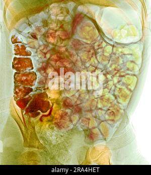 Normal barium contrast abdominal X-ray Stock Photo - Alamy