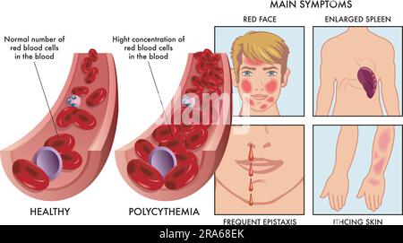 Medical illustration compares an artery with a normal number of red blood cells, with one affected by polycythemia, with drawings to the right showing Stock Vector