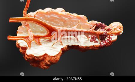 Pancreatic illness, digestive gland, Human pancreas cancer anatomy diagram, medically accurate, malignant tumor growing and spreading, mutating cells, Stock Photo