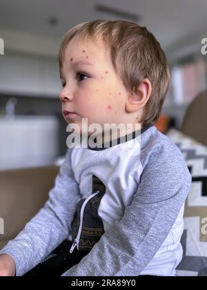 Chickenpox bubble rash on child face. Sick child with chickenpox. Stock Photo