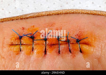 Wound on hand after surgery, freshly sutured Stock Photo