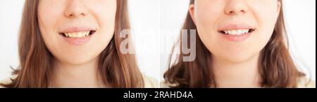 person smiles, shows teeth, yellow plaque, crooked teeth, malocclusion. before and after bleach whitening. Stock Photo