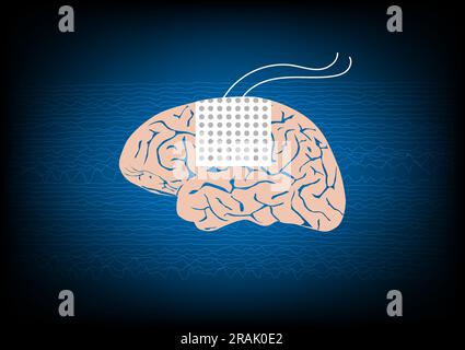 Illustration of subdural electrode over brain surface for EEG or brain waves monitoring in epilepsy surgery. Stock Vector