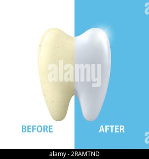 Vector 3d Realistic Render Denture Closeup Isolated on White Background ...