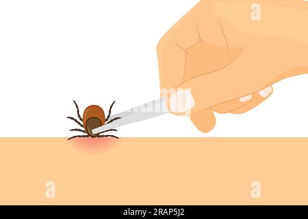 removing tick using tweezers, risk of infection of lyme and tick-borne disease- vector illustration Stock Vector