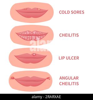 Mouth disease medical set of sore lips icons Stock Vector