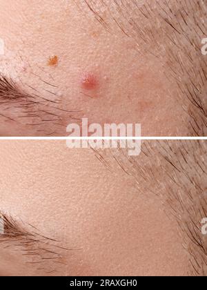 Collage with photos of man with acne problem before and after treatment, closeup Stock Photo