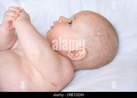 a baby boy with atopic dermatitis on his left cheek lying on a white cloth, closeup inflamed skin on face, head, forehead Stock Photo