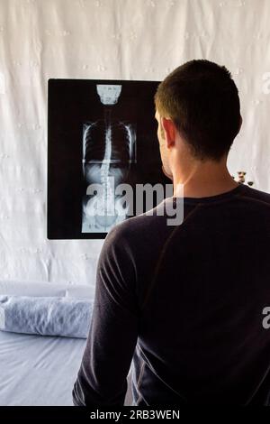 Image of a therapist analyzing a radiograph for a case study of a patient with scoliosis. Treatment and therapies to improve the patient's condition. Stock Photo