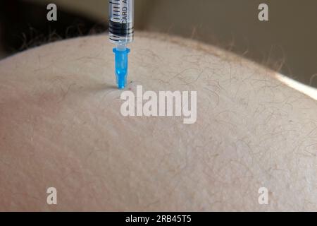 Needle injecting into the muscle. Nurse doing a trigger point injection in patient back. Close up doctor makes an shot therapy. Alternative pain treat Stock Photo