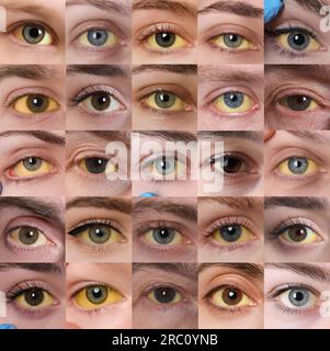 Yellowing Of Eyes As Symptom Of Hepatitis. Collage With Photos Of ...