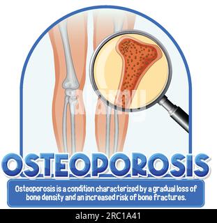 Informative poster of Osteoporosis human bone illustration Stock Vector