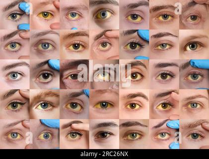 Yellowing Of Eyes As Symptom Of Hepatitis. Collage With Photos Of ...