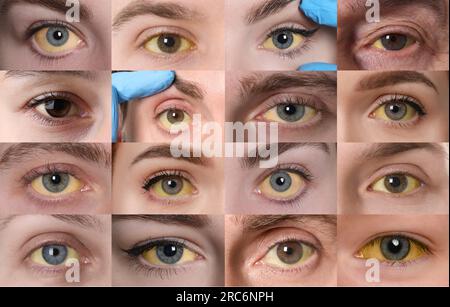 Yellowing Of Eyes As Symptom Of Hepatitis. Collage With Photos Of ...