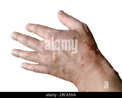 An example of a chemical burn on the hand skin obtained from such dangerous plants as hogweeds. View of a male palm on a white background - the skin o Stock Photo