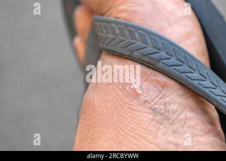 The occurrence of small, thin pieces of skin detaching from the feet as a result of wearing sandals Stock Photo