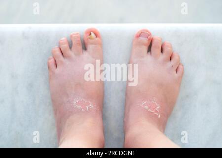 Close up sunburn peeling on the kid legs. top view. The concept of sunburn. burnt skin in the sun. close-up. Damaged skins Stock Photo