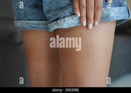 Young woman with varicose and spider veins on her leg. Close-up of skin problem on woman leg. Stock Photo