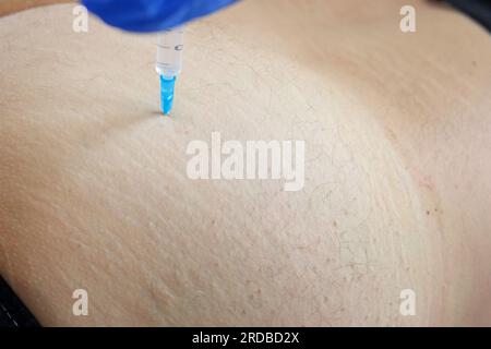 Needle injecting into the muscle. Nurse doing a trigger point injection in patient back. Close up doctor makes an shot therapy. Alternative pain treat Stock Photo