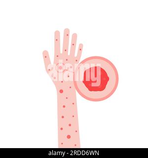 cartoon hand with psoriasis or eczema Stock Vector