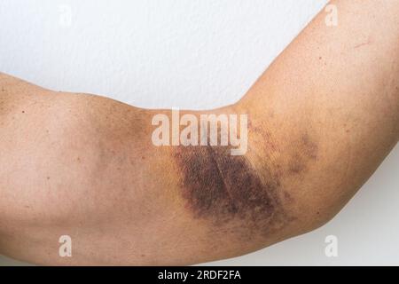 injury ligament arm bruise Stock Photo - Alamy