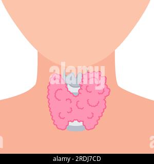 Enlarged thyroid gland, illustration Stock Photo