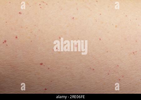 Many small red hemangioma spots on the upper arm skin of an 55 years old caucasian woman. Abnormal amount and unusual age of patient. Close up photo. Stock Photo