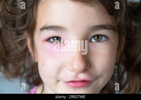 A red swollen eyelid on a child  face in close-up is an allergy to an insect bite. Allergic reaction to blood-sucking insects Stock Photo