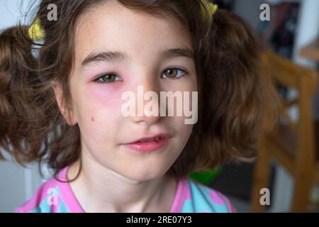 A red swollen eyelid on a child  face in close-up is an allergy to an insect bite. Allergic reaction to blood-sucking insects Stock Photo