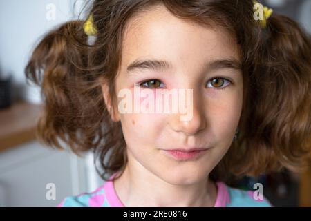 A red swollen eyelid on a child  face in close-up is an allergy to an insect bite. Allergic reaction to blood-sucking insects Stock Photo