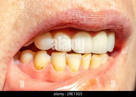 Dental calculus on teeth, sign of smoking habits. Bacterial plaque on smokers teeth Stock Photo
