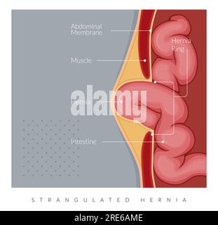 A Human Anatomy Strangulated Hernia illustration Stock Vector Image ...