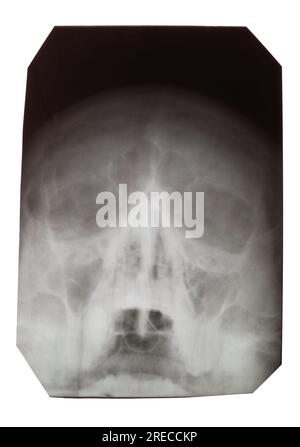 X-ray of a human skull on a white background Stock Photo