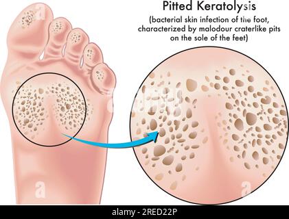 Medical illustration of symptoms of pitted keratolysis, a bacterial skin infection of the foot. Stock Vector