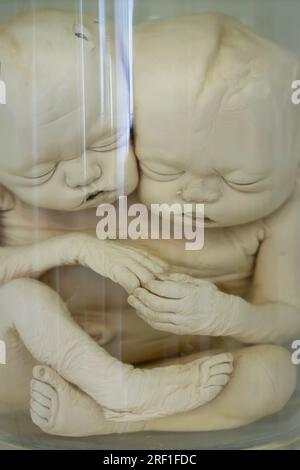 April 1, 2023 - Gomel: fully plastinated Siamese twins at an anatomical exhibition with plastinated cadavers. Embalmed Siamese twins.Spirited Siamese Stock Photo