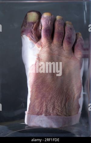 April 1, 2023. Gomel. Exhibition of anatomical exhibits. The frostbitten part of a human leg is presented as an anatomical exhibit preserved in alcoho Stock Photo