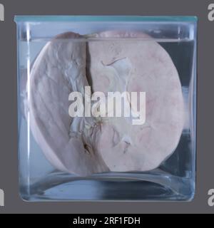 April 1, 2023. Gomel. Exhibition of anatomical exhibits. A human kidney with a stone is an anatomical exhibit preserved in alcohol in a formaldehyde s Stock Photo