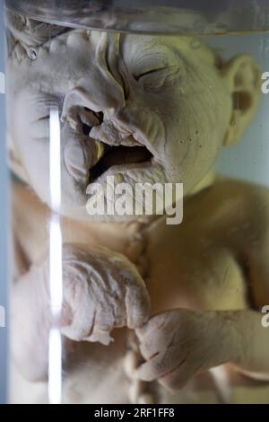 April 1, 2023. Gomel. Exhibition of anatomical exhibits. Human infant with pathological development of cleft lip, cleft palate. Stock Photo