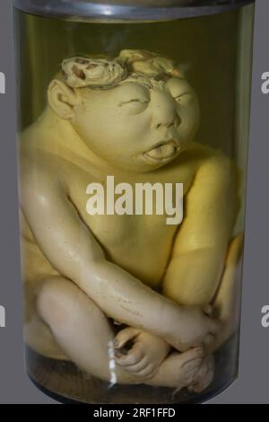 April 1, 2023. Gomel. Exhibition of anatomical exhibits. A human infant with the pathological development of anencephaly - the absence of most of the Stock Photo