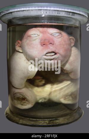 April 1, 2023. Gomel. Exhibition of anatomical exhibits. Human infant with pathological development of nonunion of the spinal canal. Rachioschis. Defe Stock Photo