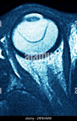 Retinal Detachment Of The Left Eye, Visualized By Radial Section Mri 