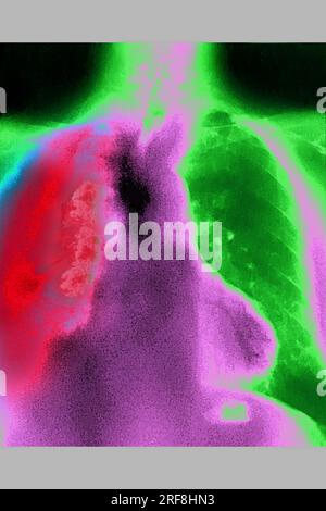 Lung cancer (right), visualized by an AP chest X-ray. Stock Photo