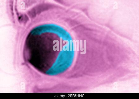 Retinal detachment of the left eye, visualized by radial section MRI. Stock Photo