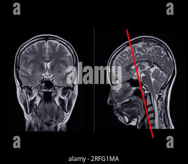 MRI brain scan Compare Coronal and sagittal plane for detect Brain ...