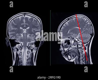 MRI brain scan Compare Coronal and sagittal plane for detect Brain ...