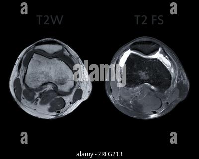 Magnetic resonance imaging or MRI of  knee joint Axial view T2 and T2 FS  for detect tear or sprain of the anterior cruciate  ligament (ACL) Stock Photo