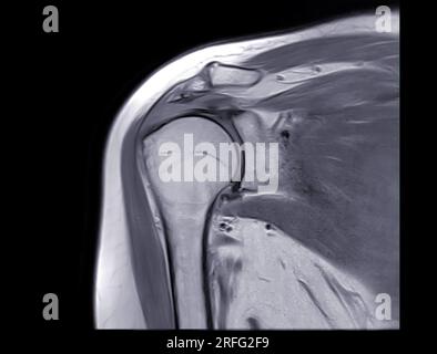 Magnetic Resonance Imaging or MRI of Shoulder Joint for diagnostic ...